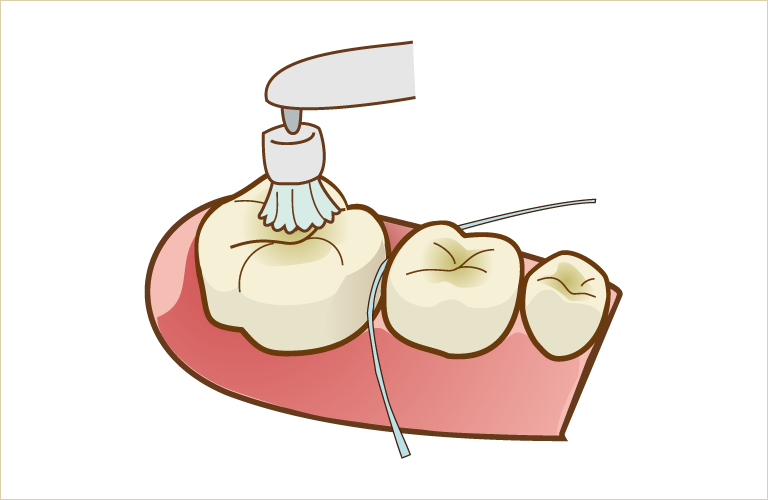 おおいし歯科の歯科衛生士によるクリーニング